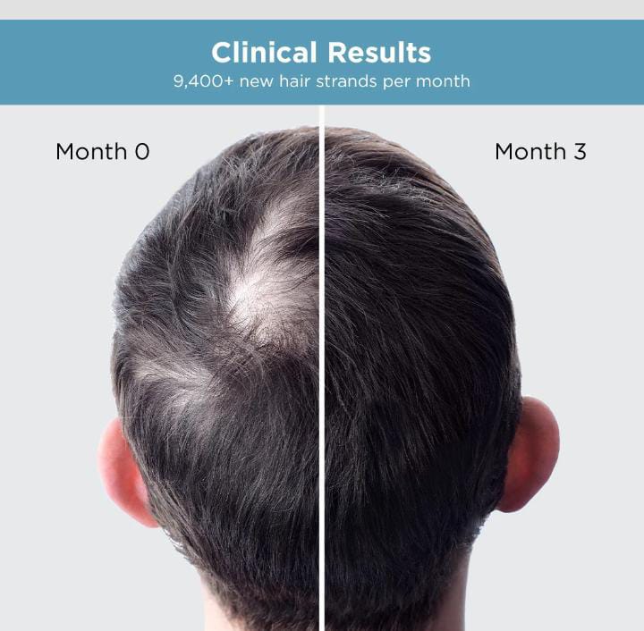 The Man Company Hair Growth Serum – Anagain 4% + Redensyl 3% + Baicapil 3% (30ml)